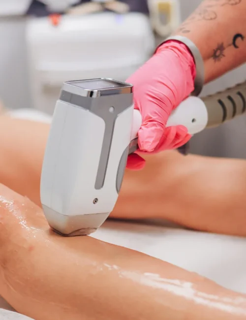 depilacion laser (1)